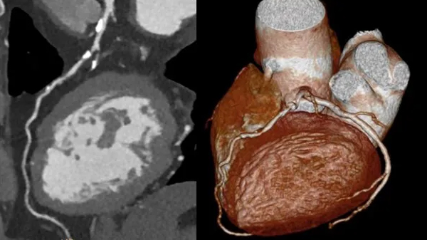 kardio ct bochum kardio ct bildgebung beispiel