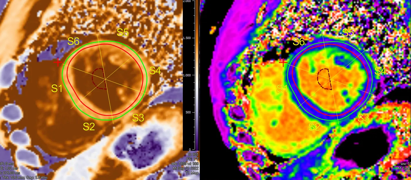kardio mrt kardio mrt bildgebung beispiel
